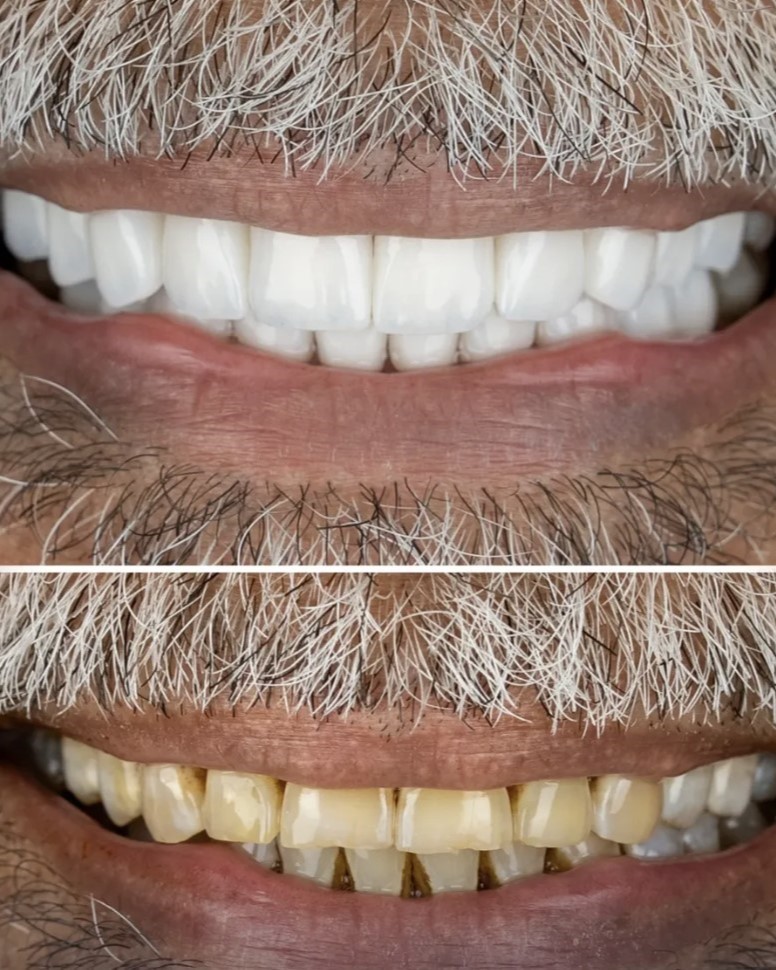 Digital smile design