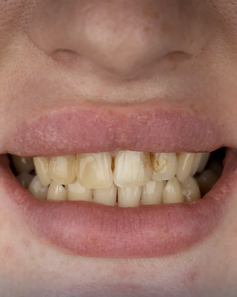 Smile transformation 4