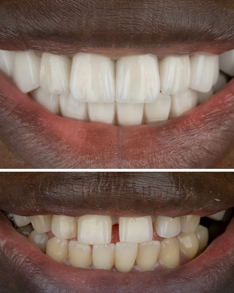 Laser dentistry